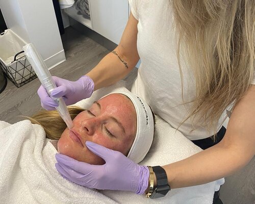 A practitioner performing medical microneedling on a patient
